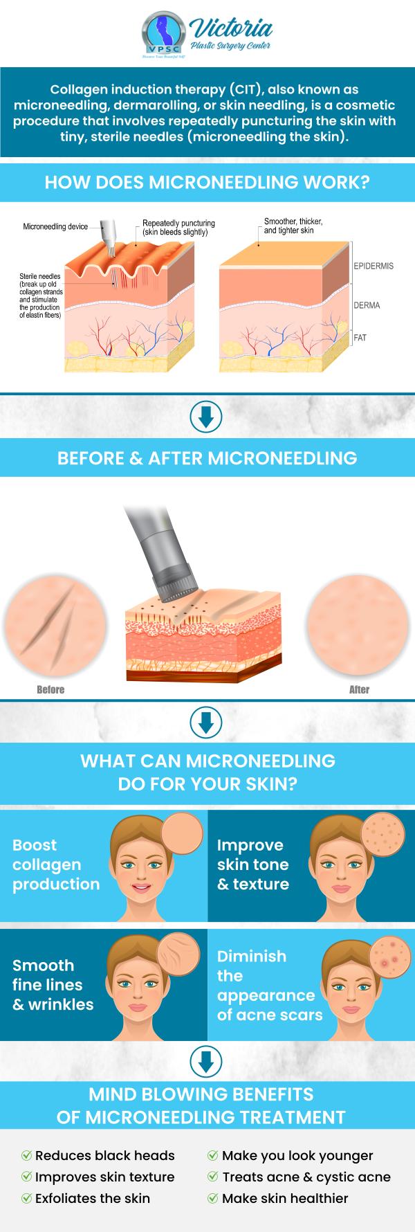 Microneedling helps improve the texture and appearance of your skin. It reduces scars, acne scars, wrinkles, stretch marks, and other skin problems. Dr. Suh at Victoria Plastic Surgery offers microneedling treatments in Fairfax, VA.  For more information, please contact us or book an appointment online. We are conveniently located at 8503 Arlington Blvd #130 Fairfax, VA 22031. 