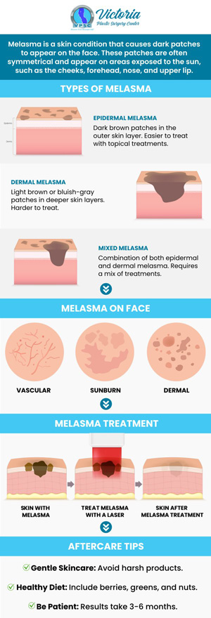 Melasma can be uncomfortable to anyone dealing with it and can cause feelings of discomfort in your skin. Meet Dr. Suh at Victoria Plastic Surgery Center today for our Melasma Treatment to lighten the color of melasma on your skin and see your self-esteem and confidence rise again! For more information, please contact us or book an appointment online. We are conveniently located at 8503 Arlington Blvd #130 Fairfax, VA 22031. Melasma can be uncomfortable to anyone dealing with it and can cause feelings of discomfort in your skin. Meet Dr. Suh at Victoria Plastic Surgery Center today for our Melasma Treatment to lighten the color of melasma on your skin and see your self-esteem and confidence rise again! For more information, please contact us or book an appointment online. We are conveniently located at 8503 Arlington Blvd #130 Fairfax, VA 22031.